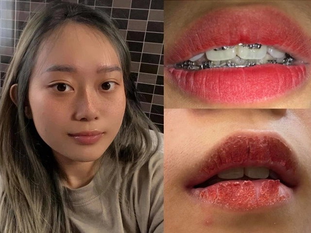 Hòa minzy khóc ròng khi mặt bong tróc từng mảng nhăn nheo như bà già - 10