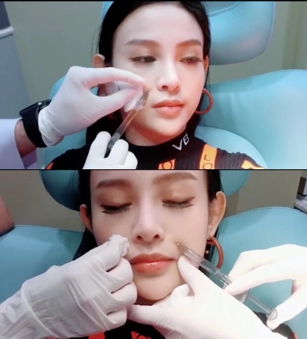 Huyền baby tiêm filler lên mũi cằm thon gọn hàm để trở nên hoàn mỹ - 2