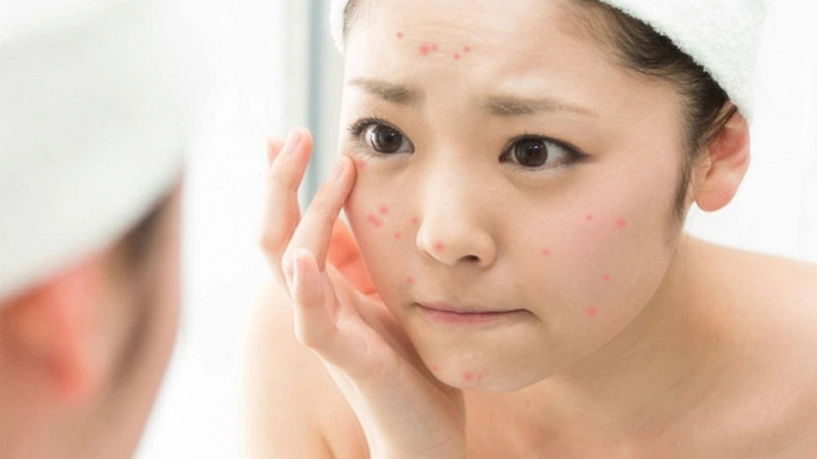 Không lo thâm sẹo với top 5 bí quyết chăm sóc da sau khi nặn mụn tại nhà đơn giản - 3