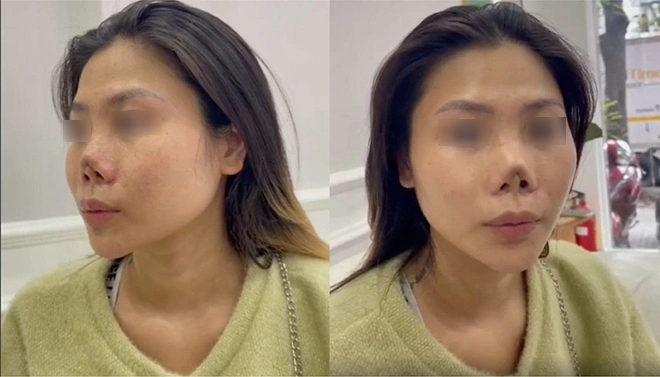 Cô gái kể chuyện sửa mũi hỏng tại bác sĩ hồ phi nhạn - 2