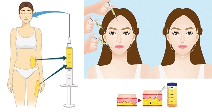 Hoa hậu indonesia hỏng mặt vì phẫu thuật thẩm mỹ chuyên gia nói gì về trường hợp này - 5