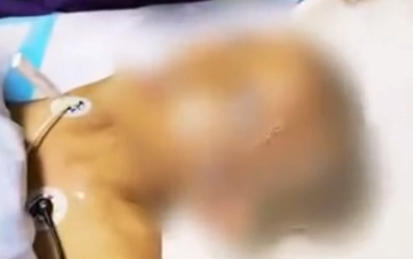 Mẹ làm theo mẹo dân gian đổ thuốc trừ sâu lên đầu diệt chấy bé 11 tuổi nguy kịch - 1