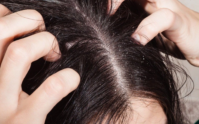 Mẹ làm theo mẹo dân gian đổ thuốc trừ sâu lên đầu diệt chấy bé 11 tuổi nguy kịch - 3