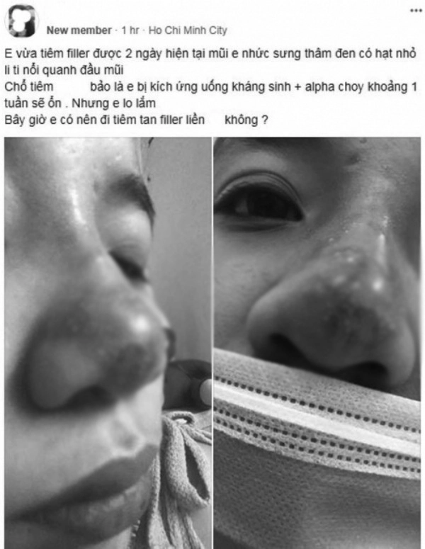 Mê tiêm filler giá rẻ nhiều chị em đối mặt hậu quả rùng mình mặt sưng mũi mưng mủ - 1