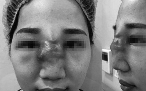 Mê tiêm filler giá rẻ nhiều chị em đối mặt hậu quả rùng mình mặt sưng mũi mưng mủ - 2