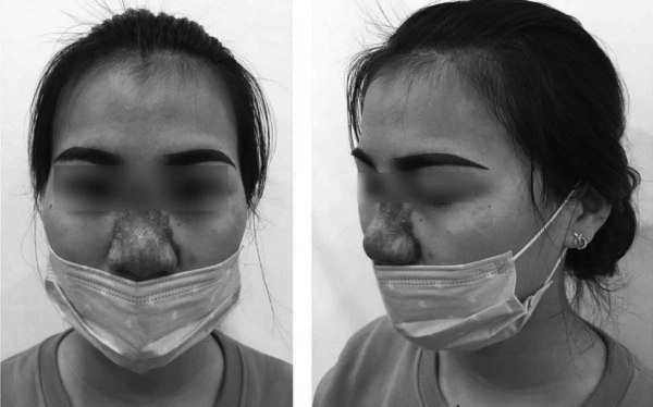 Mê tiêm filler giá rẻ nhiều chị em đối mặt hậu quả rùng mình mặt sưng mũi mưng mủ - 3