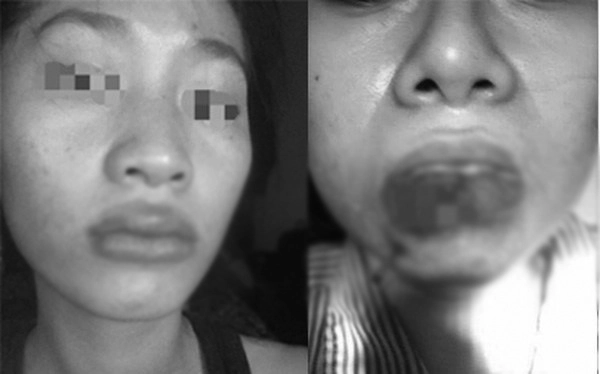 Mê tiêm filler giá rẻ nhiều chị em đối mặt hậu quả rùng mình mặt sưng mũi mưng mủ - 4