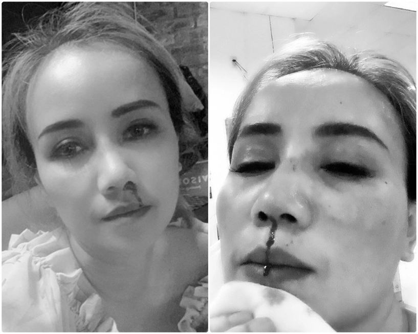 Nâng mũi chưa lâu đã gặp tai nạn chị em gặp tình cảnh như cô xuyến cần làm gì - 2