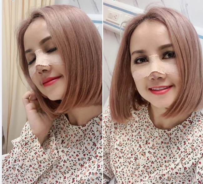 Nâng mũi chưa lâu đã gặp tai nạn chị em gặp tình cảnh như cô xuyến cần làm gì - 3