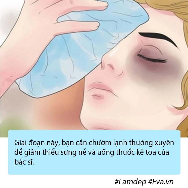 Nâng mũi chưa lâu đã gặp tai nạn chị em gặp tình cảnh như cô xuyến cần làm gì - 5