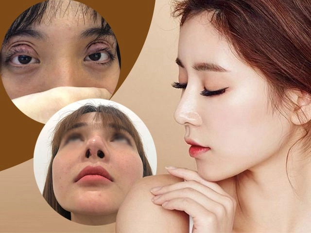 Nâng mũi chưa lâu đã gặp tai nạn chị em gặp tình cảnh như cô xuyến cần làm gì - 9