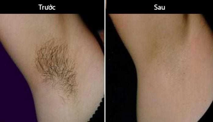 Triệt lông nách biện pháp thẩm mỹ cứu cánh của phái đẹp ngày hè oi bức - 6