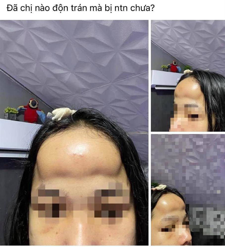 Đi độn trán chưa thấy vầng trán thanh lịch đâu cô nàng nhận về cái kết sưng như ong chích - 2