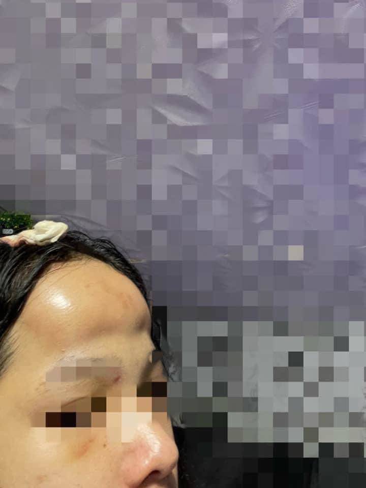 Đi độn trán chưa thấy vầng trán thanh lịch đâu cô nàng nhận về cái kết sưng như ong chích - 3