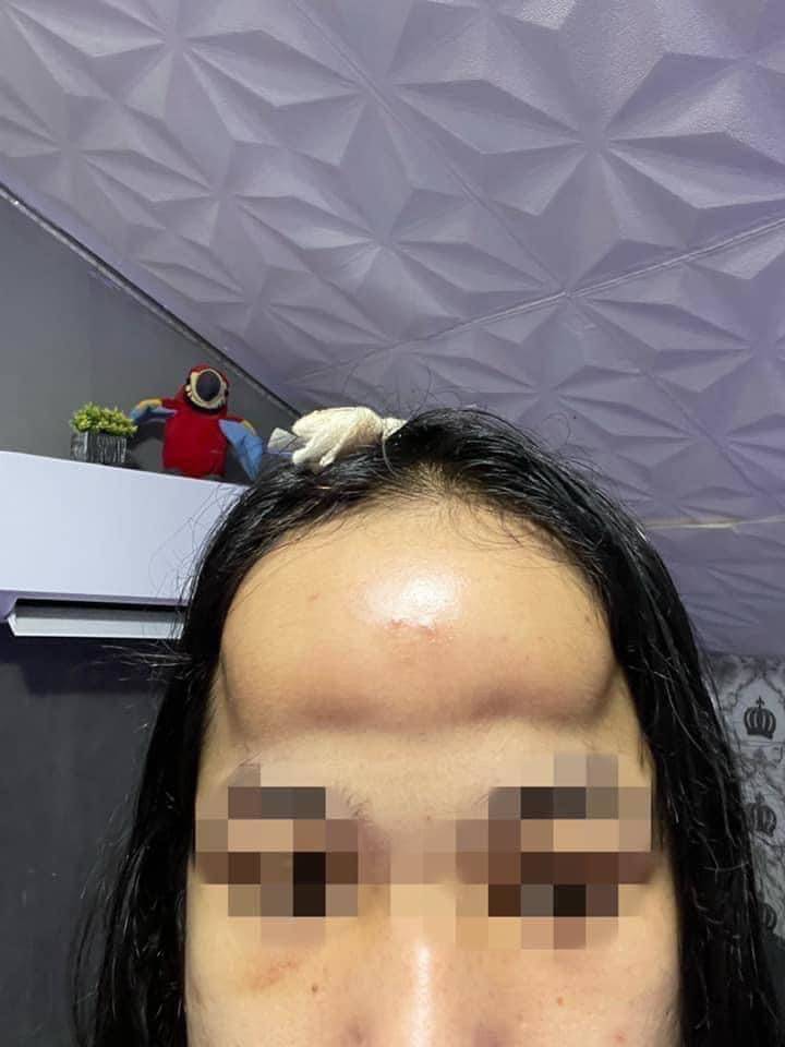 Đi độn trán chưa thấy vầng trán thanh lịch đâu cô nàng nhận về cái kết sưng như ong chích - 4