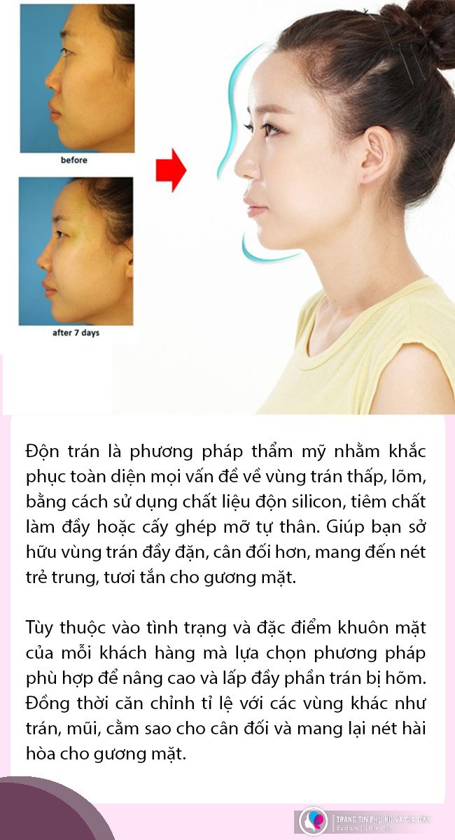 Đi độn trán chưa thấy vầng trán thanh lịch đâu cô nàng nhận về cái kết sưng như ong chích - 6