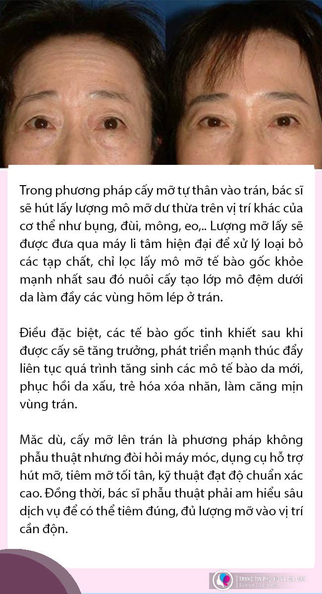 Đi độn trán chưa thấy vầng trán thanh lịch đâu cô nàng nhận về cái kết sưng như ong chích - 8