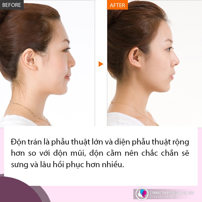 Đi độn trán chưa thấy vầng trán thanh lịch đâu cô nàng nhận về cái kết sưng như ong chích - 10