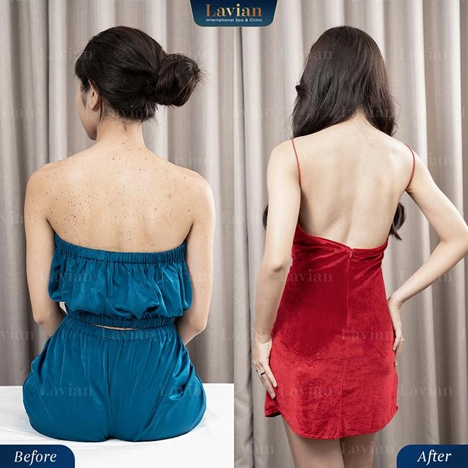 Giải cứu da viêm mụn thâm sần lâu năm bằng công nghệ bioskin từ nhật bản - 3