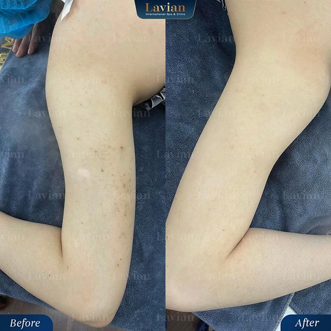 Giải cứu da viêm mụn thâm sần lâu năm bằng công nghệ bioskin từ nhật bản - 4