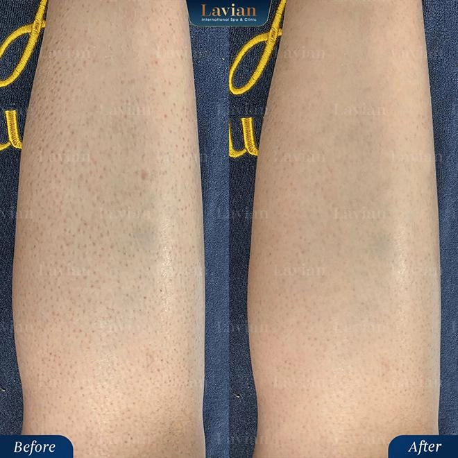 Giải cứu da viêm mụn thâm sần lâu năm bằng công nghệ bioskin từ nhật bản - 5