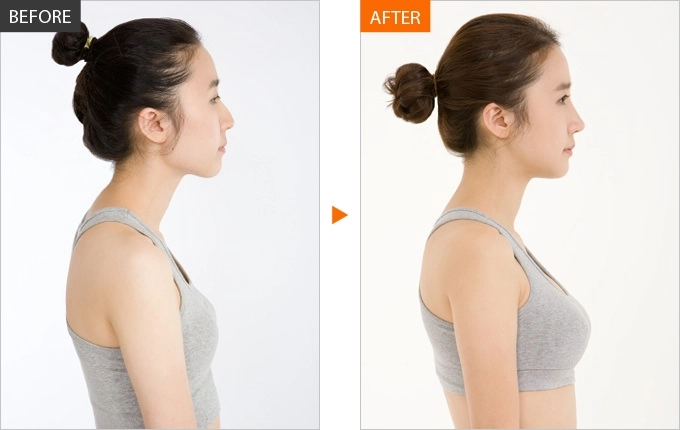 Nâng ngực 5 câu hỏi bạn cần phải biết về tình trạng núi đôi của mình trước khi trùng tu - 2