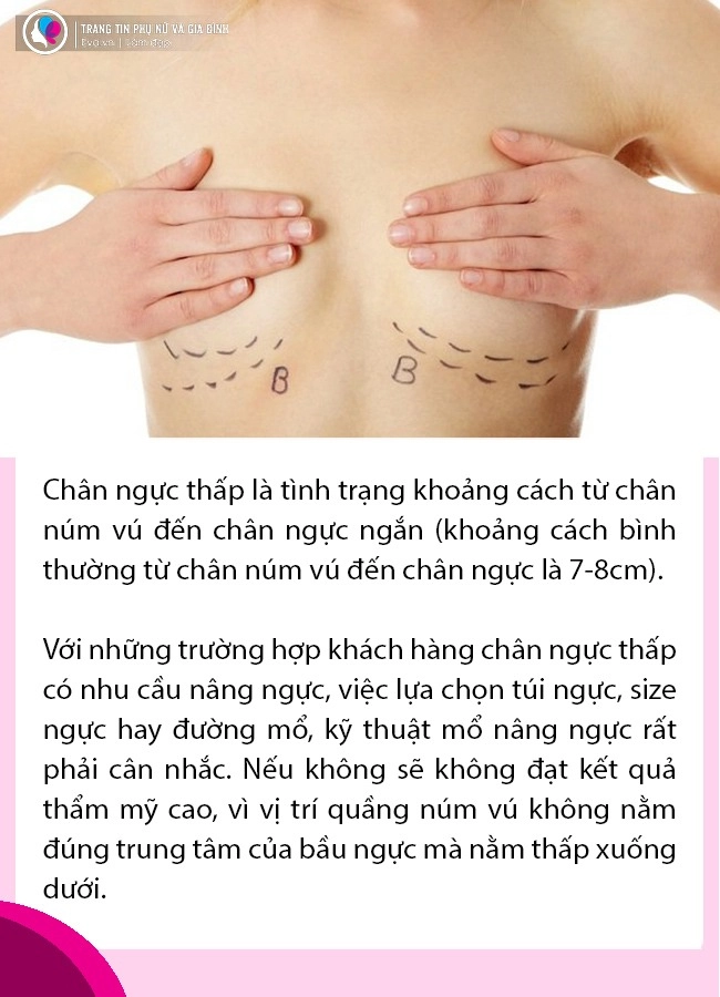 Nâng ngực 5 câu hỏi bạn cần phải biết về tình trạng núi đôi của mình trước khi trùng tu - 5