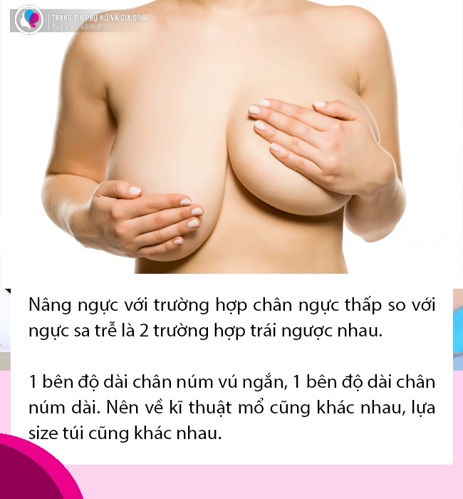 Nâng ngực 5 câu hỏi bạn cần phải biết về tình trạng núi đôi của mình trước khi trùng tu - 6