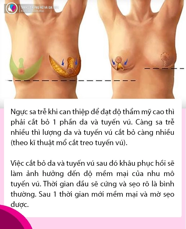 Nâng ngực 5 câu hỏi bạn cần phải biết về tình trạng núi đôi của mình trước khi trùng tu - 7
