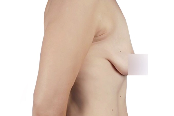 Muốn nâng ngực sau sinh nhất định phải biết những điều này - 3