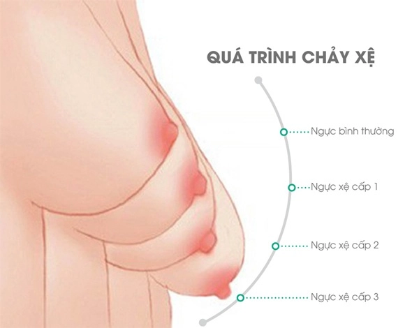 Muốn nâng ngực sau sinh nhất định phải biết những điều này - 5