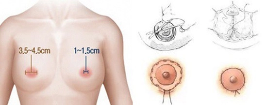 Muốn nâng ngực sau sinh nhất định phải biết những điều này - 7
