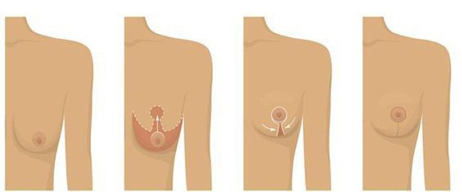 Muốn nâng ngực sau sinh nhất định phải biết những điều này - 9