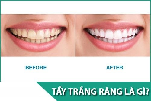 Tẩy trắng răng có hại gì với sức khỏe và những đối tượng không nên tẩy - 1