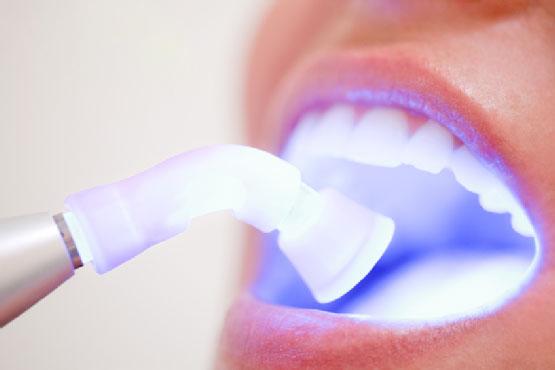 Tẩy trắng răng có hại gì với sức khỏe và những đối tượng không nên tẩy - 4