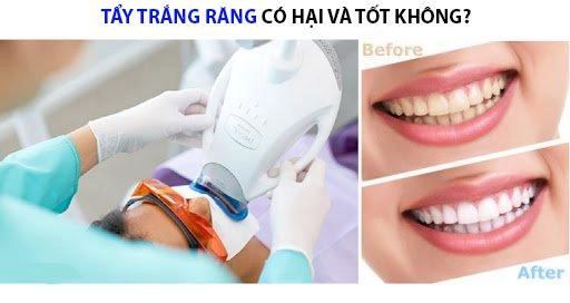 Tẩy trắng răng có hại gì với sức khỏe và những đối tượng không nên tẩy - 5