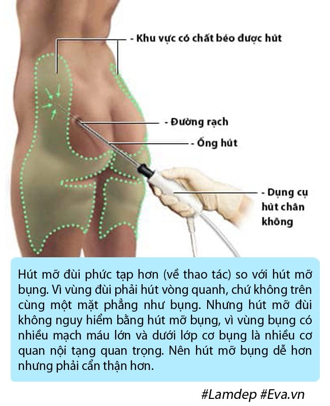 bom sex anh phải nằm ngửa treo 2 chân lên cao trong nhiều ngày vì phù nề sau hút mỡ - 6