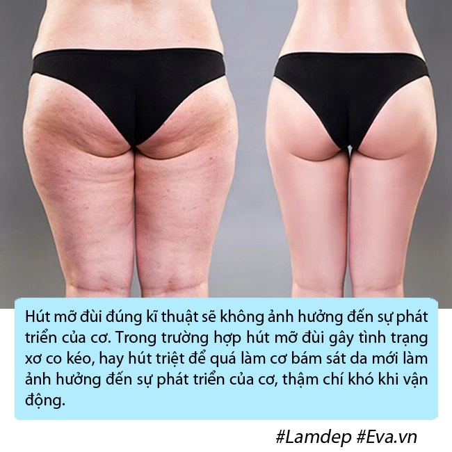 bom sex anh phải nằm ngửa treo 2 chân lên cao trong nhiều ngày vì phù nề sau hút mỡ - 7