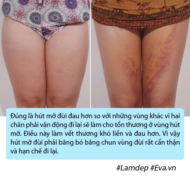 bom sex anh phải nằm ngửa treo 2 chân lên cao trong nhiều ngày vì phù nề sau hút mỡ - 8