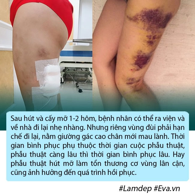 bom sex anh phải nằm ngửa treo 2 chân lên cao trong nhiều ngày vì phù nề sau hút mỡ - 10