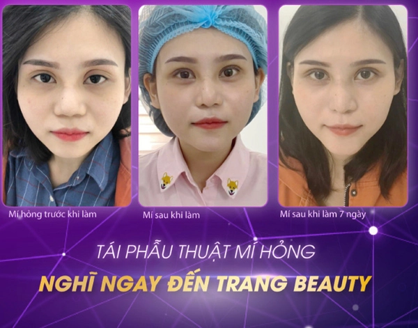 Công nghệ t-2020 - giải pháp tái phẫu thuật mí hỏng hoàn hảo - 2