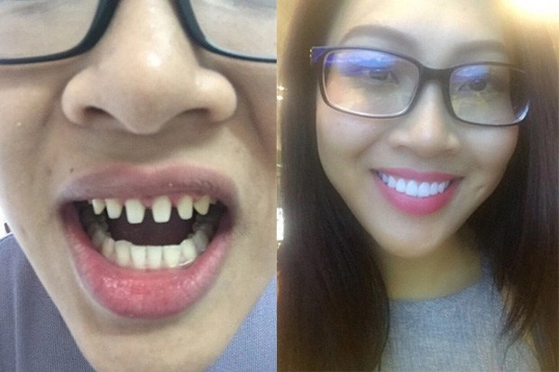 Làng nhan sắc xém nữa đã có 1 vụ kiện giữa hai mỹ nhân chỉ vì chuyện làm răng sứ - 19