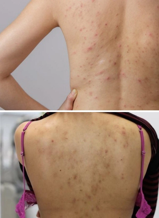 Dáng đẹp nhưng lưng mụn thâm chi chít chị em chữa liền bây giờ vẫn kịp diện bikini - 1