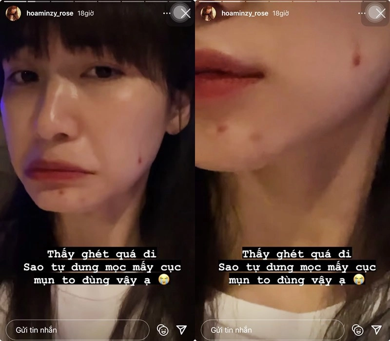 Một phút lầm lỡ bị mụn hành hòa minzy thất thế ngôi vương mặt mộc không tì vết - 4