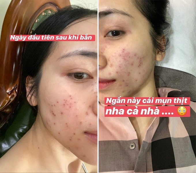 Một phút lầm lỡ bị mụn hành hòa minzy thất thế ngôi vương mặt mộc không tì vết - 6