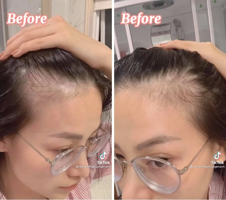 Rẻ-đẹp-dễ hoa hậu phương khánh tóc rụng cả mảng nhìn công đoạn chữa hói mới không ai ngờ - 4