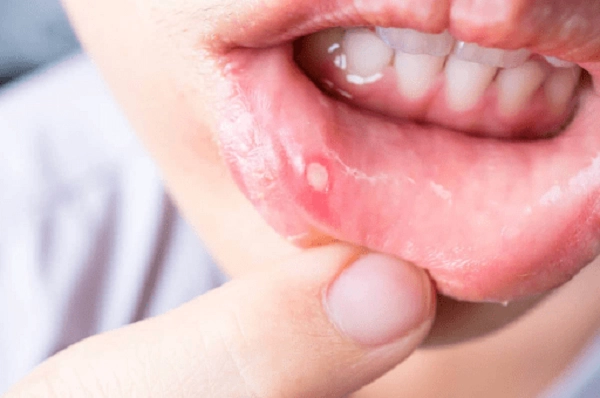 Bé bị tay chân miệng uống thuốc gì - 1