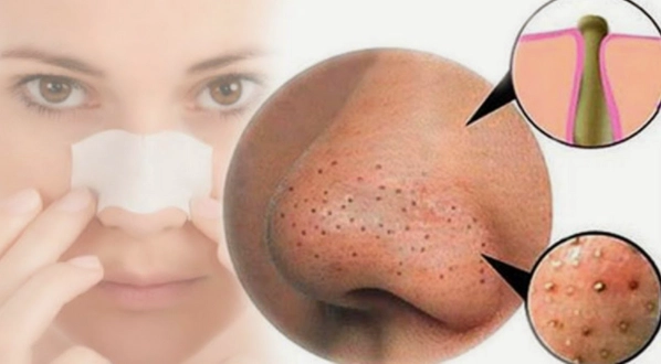Cách trị mụn đầu đen tại nhà an toàn và hiệu quả - 1