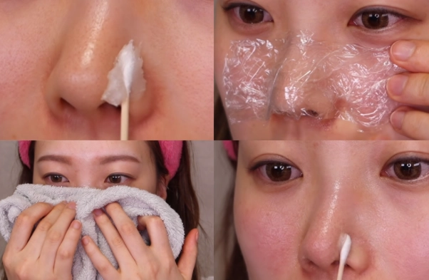 Cách trị mụn đầu đen tại nhà an toàn và hiệu quả - 10