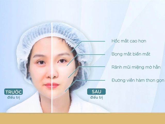 Căng da mặt và những điều cần biết để tránh hiểm họa khôn lường - 5